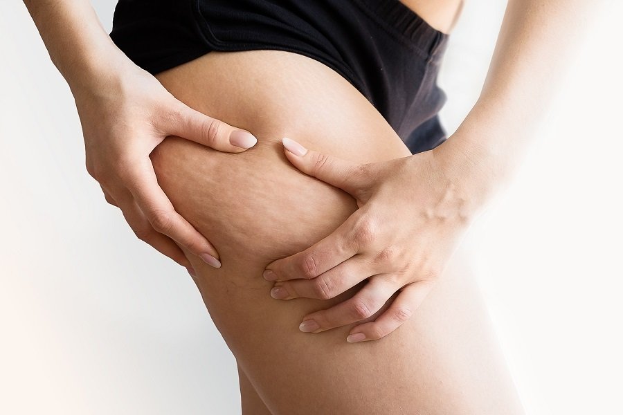 Presoterapia para reducir y eliminar la celulitis