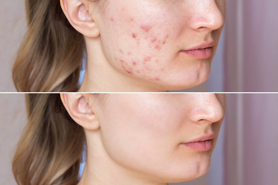 como combatir cicatrices acne