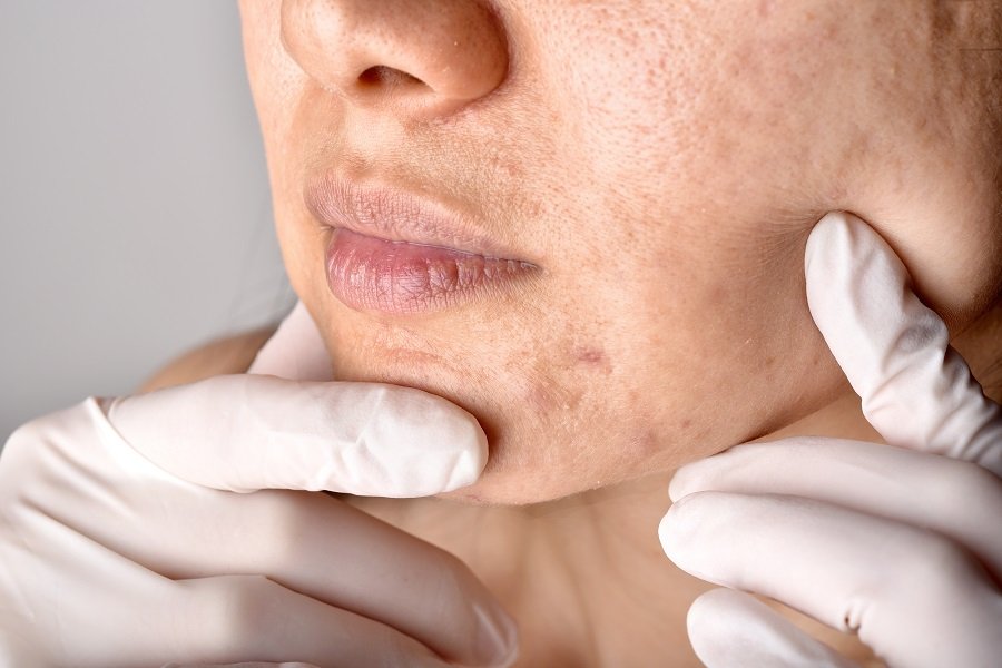 tipos cicatrices acne